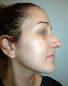 rhinoplastie