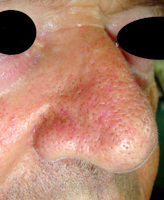 Cancer du nez et de la face