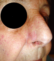 Cancer du nez et de la face